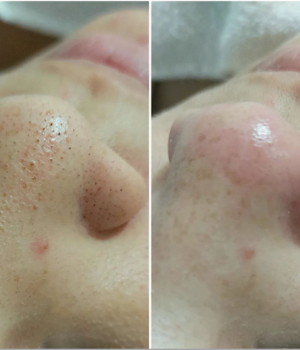 Limpeza de Pele