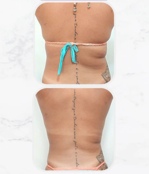 Lipo Enzimatica
