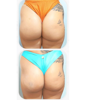 harmonização de Gluteos